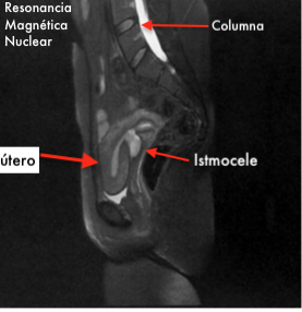 Istmocele