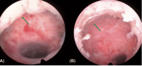 istmoxhisteroscopia